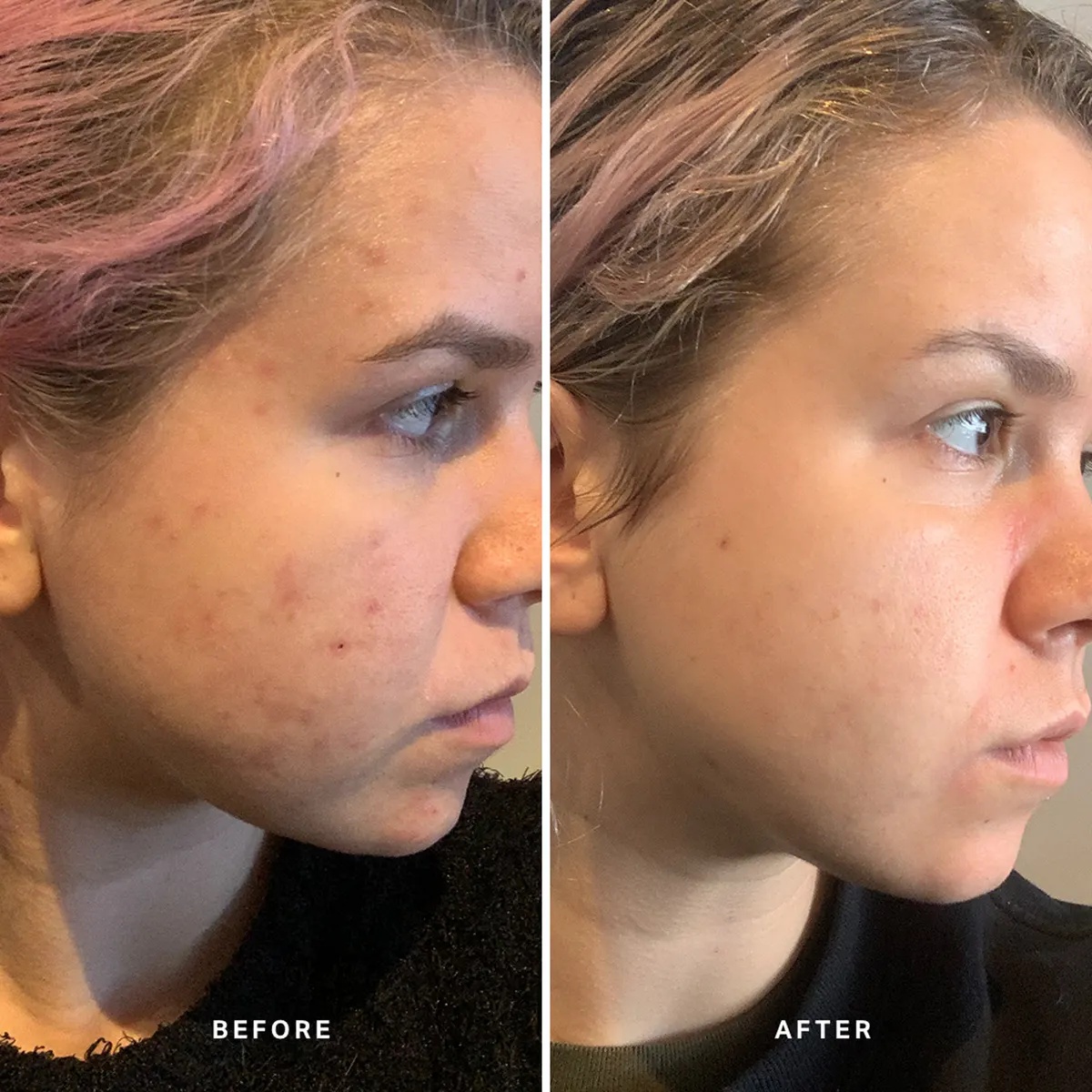 Alpha-H Instant Action BHA Blemish Treatment 20ml, view 4