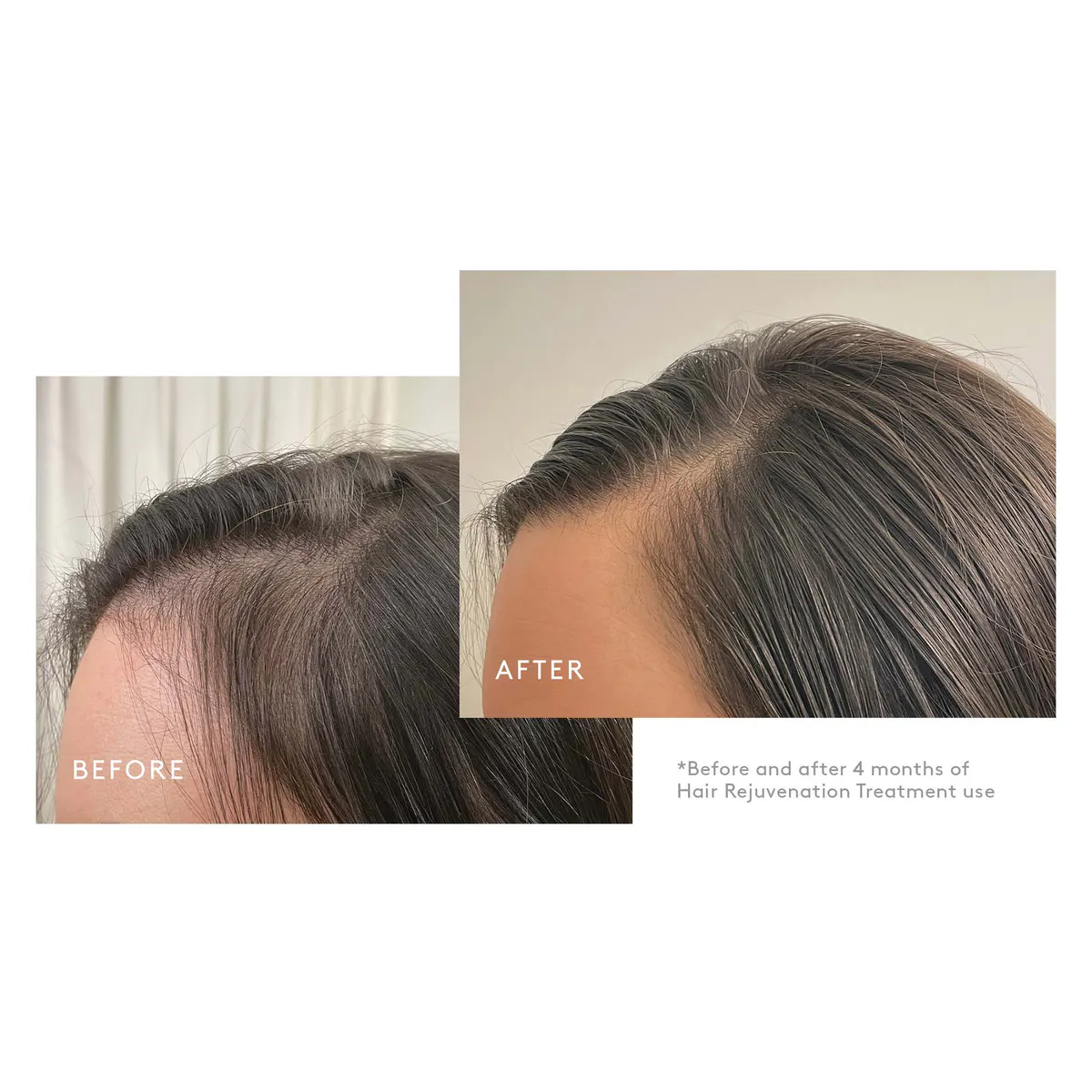 Virtue Hair Rejuvenation Treatment Kit 90day, view 4