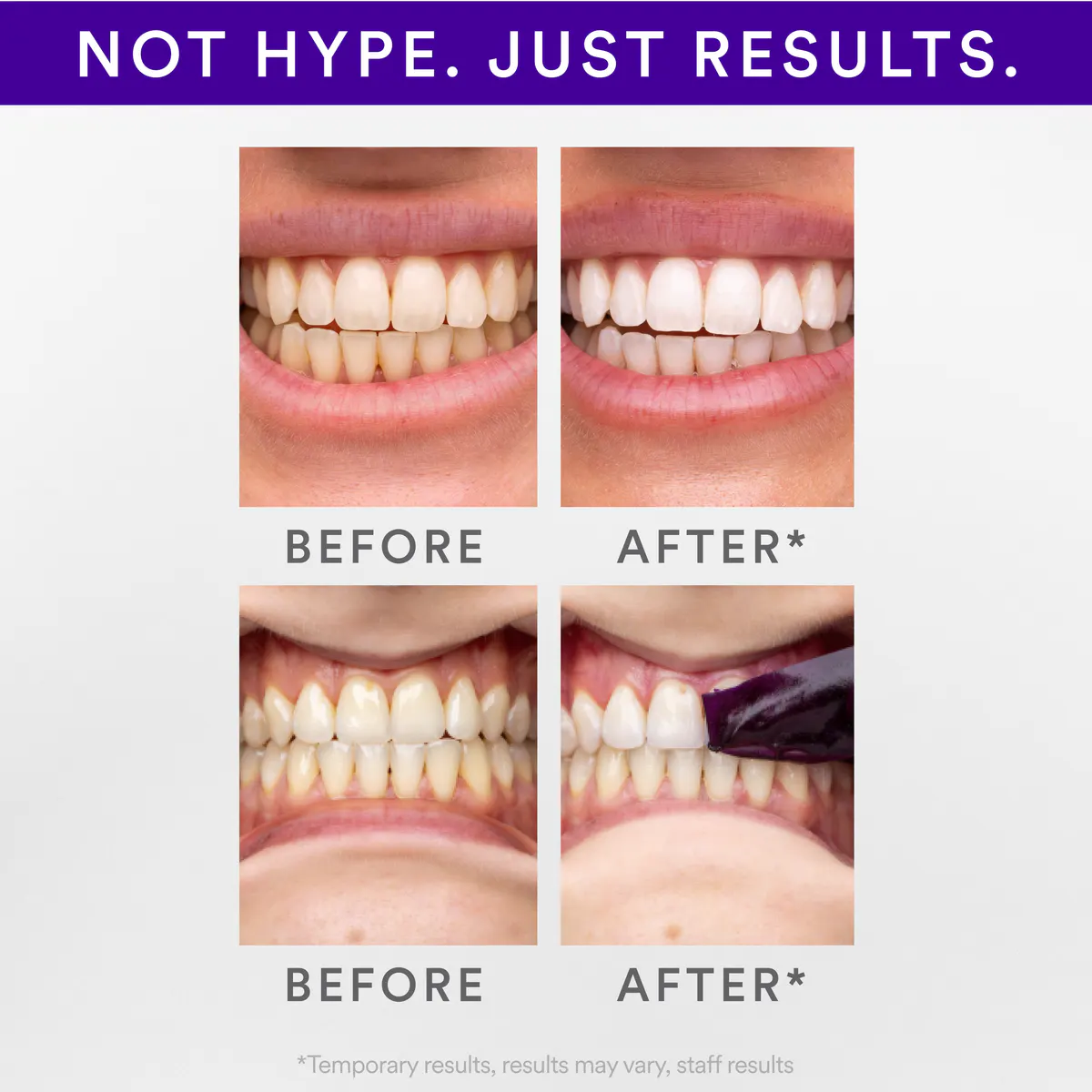Hismile V34 Teeth Whitening Strips (14pk), view 4