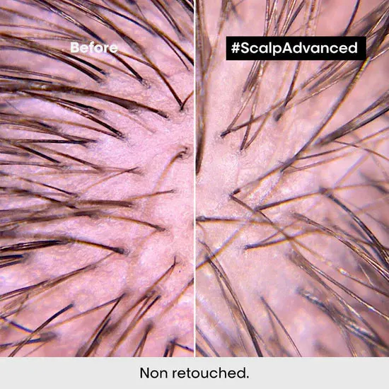 L'Oréal Professionnel Scalp Advanced Anti-Discomfort Duo Bundle, view 4