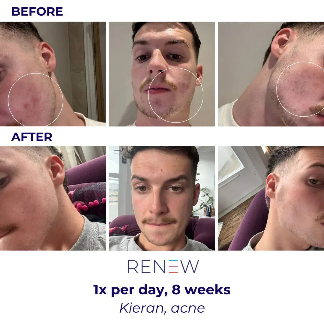 Lustre ClearSkin Renew Pro Beauty LED Mask, view 2