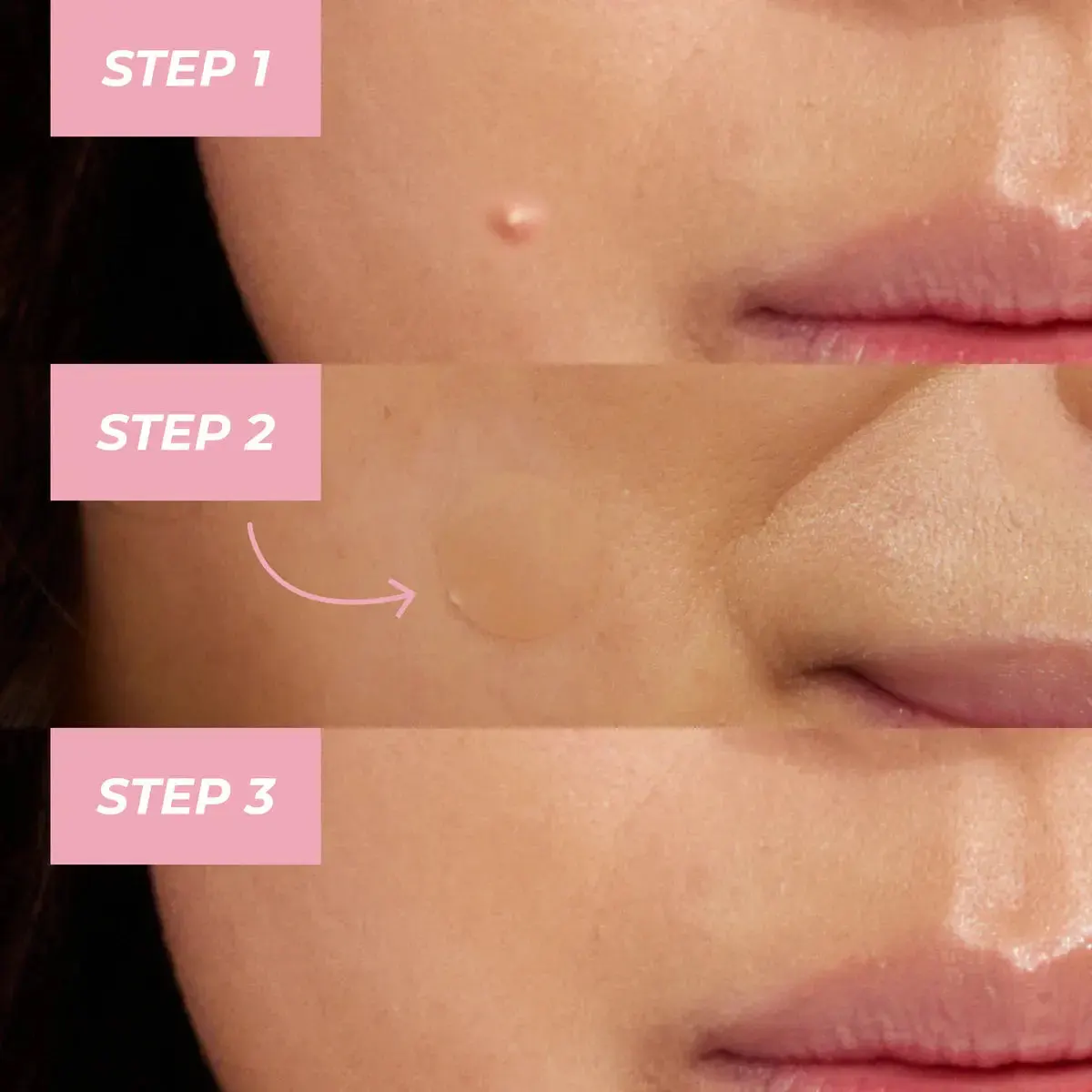 MCoBeauty Clear Miracle Xtreme Day & Night Pimple Patches, view 2