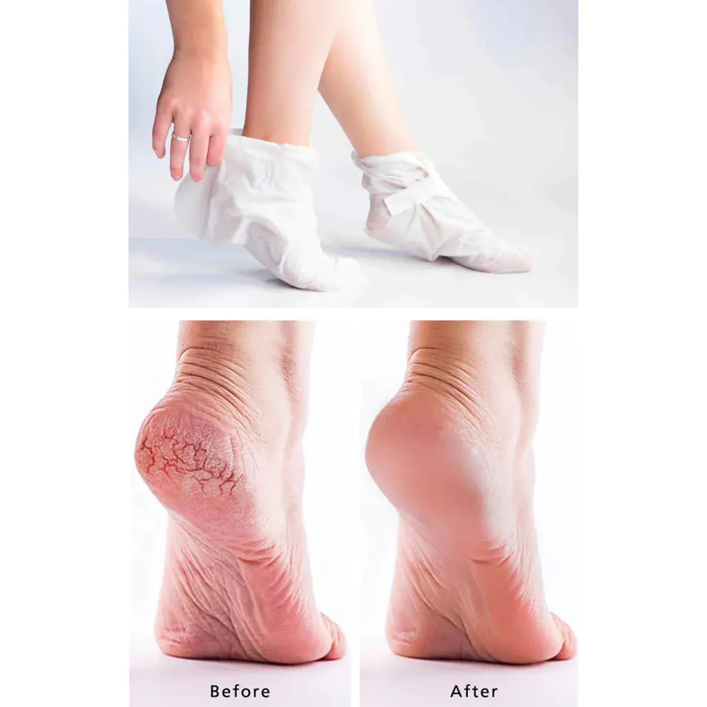 MEDIHEAL Paraffin Foot Sheet Mask Bundle (5 Pairs), view 2