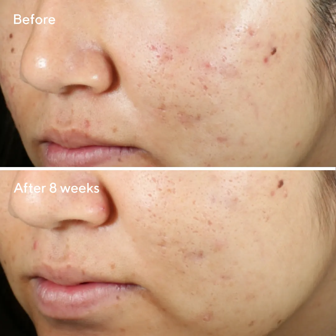 Murad Invisiscar Resurfacing Treatment 15ml, view 2