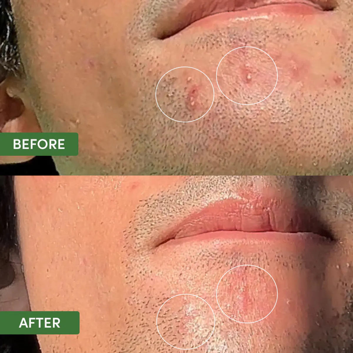 Sand & Sky Oil Control Dual Action Blemish Patches, view 3